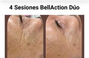 Bellaction Duo tratamiento facial y corporal